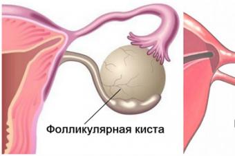 Геморроидальная киста Геморрагическая киста яичника симптомы