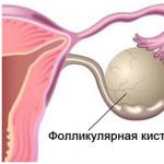 Hemorrhoidal kysta Hemorraginen munasarjakysta oireita